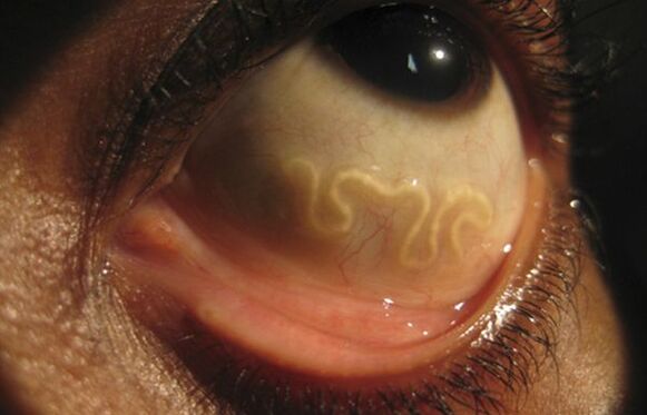 Loa Loa kirminas gyvena žmogaus akyje ir sukelia aklumą